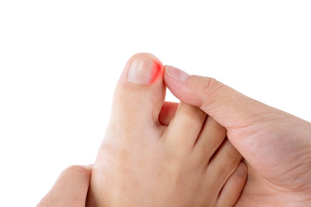 Wrastające paznokcie u nóg – przyczyny, objawy i skuteczne rozwiązania